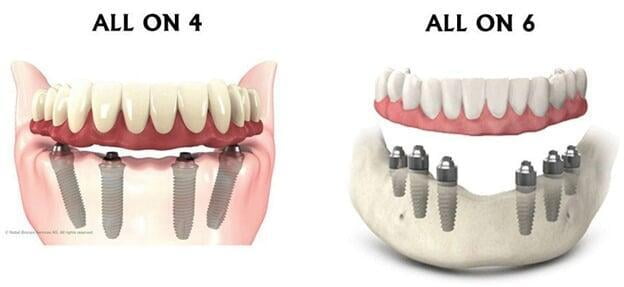 What is Right for You: All-on-6 or All-on-4 Dental Implants?